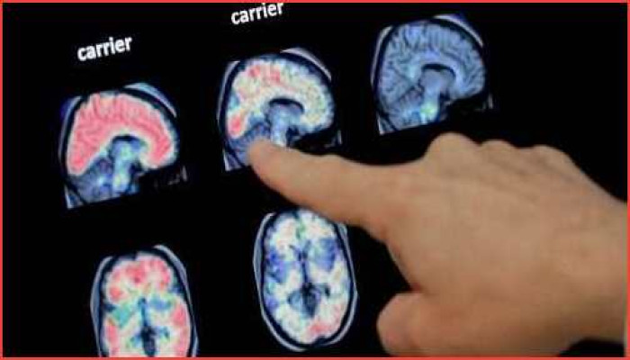 মিশিগানে ২ লাখেরও বেশি প্রবীণ নাগরিক আলঝাইমারে আক্রান্ত